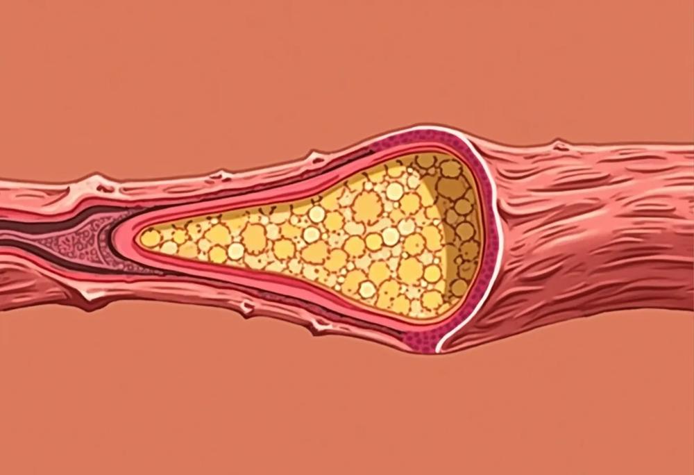 Clogged artery-e6b5652f592f45b58eac7d7330aab0f9.jpg Clogged artery