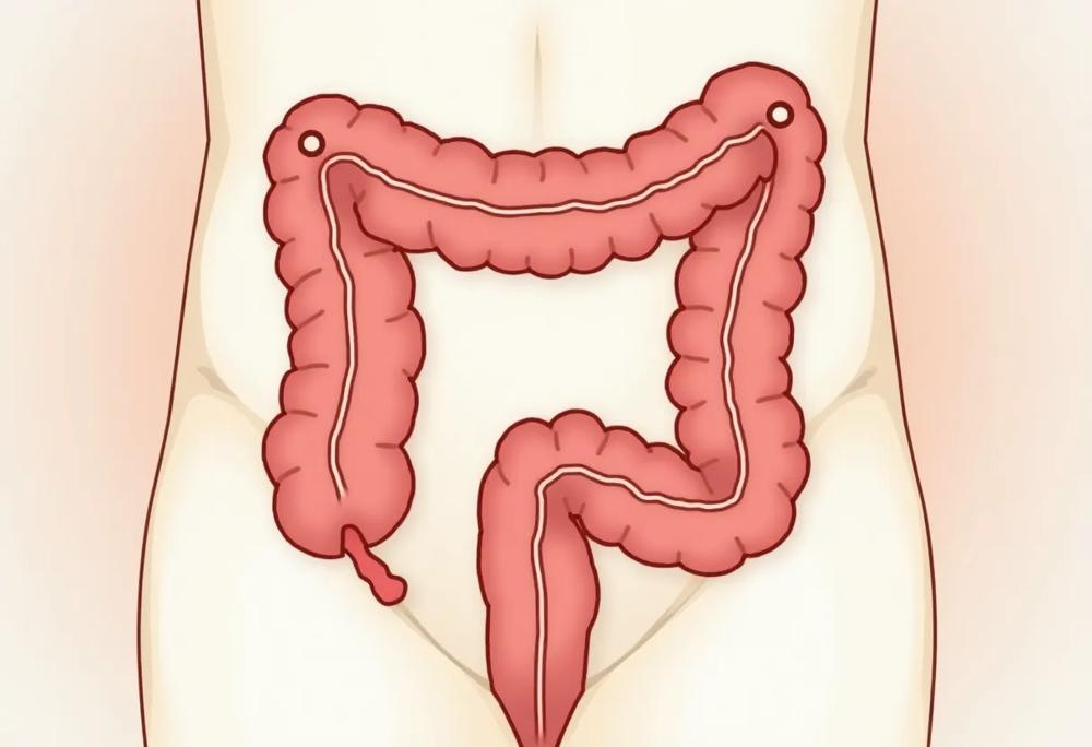 Colon diverticula-03a3234e941c46f8b71f88f6668926c6.jpg Colon diverticula