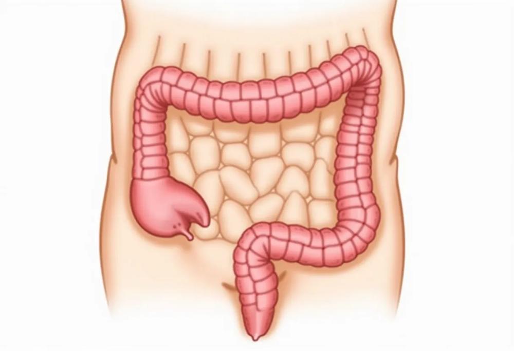 Colon diverticula-03a3234e941c46f8b71f88f6668926c6.jpg Colon diverticula