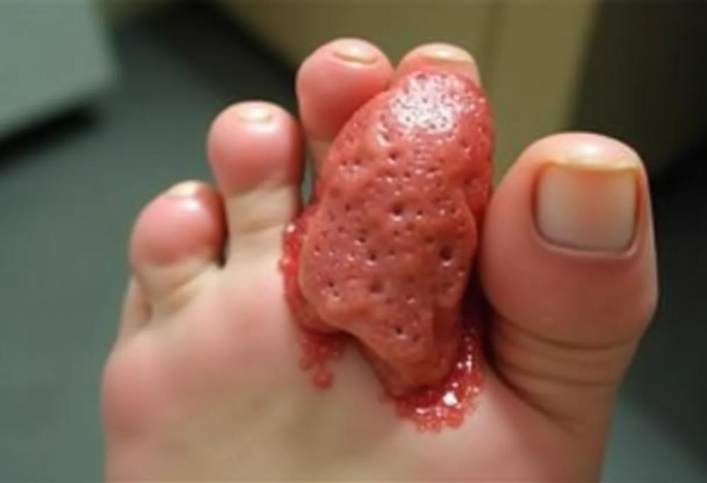 Gout toe-9045c48bb5ac44ca9ad8004909d5839b.jpg Gout toe