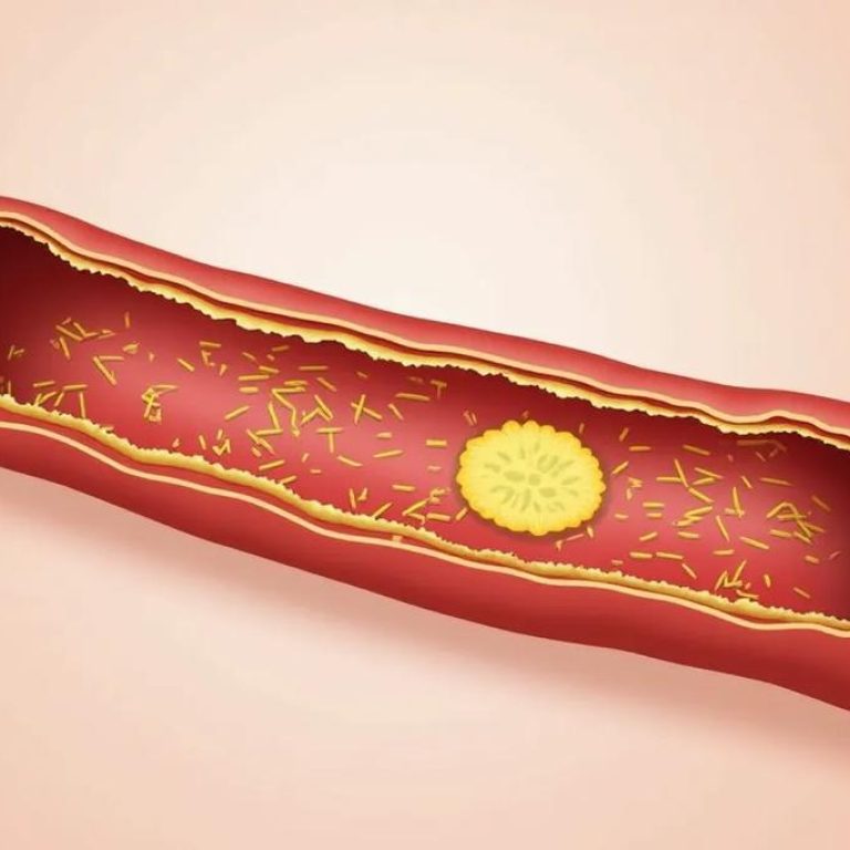 Clogged-artery-87b30c1d5818413a90e55d5d46f0a216