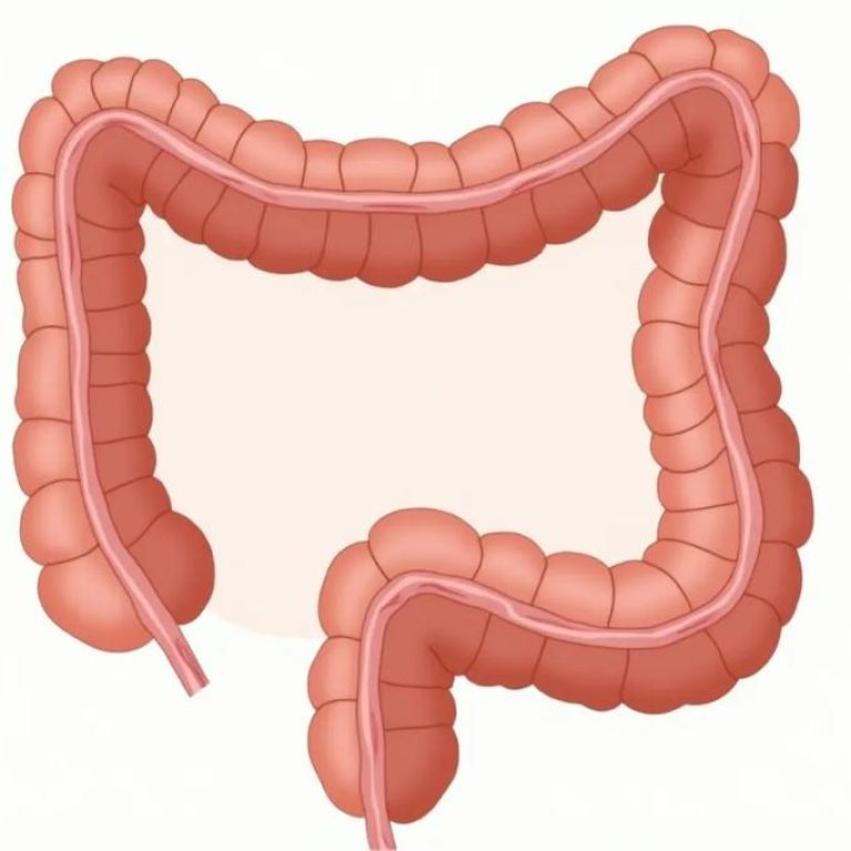 Colon-diverticula-6bb3d08b66e643c78fb92c2efb274b1c