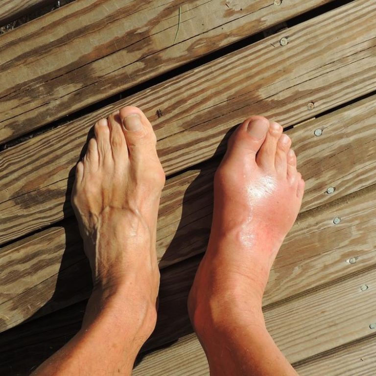 Gout-toe-65d9cd6bc9014accaf88803ac3504e36